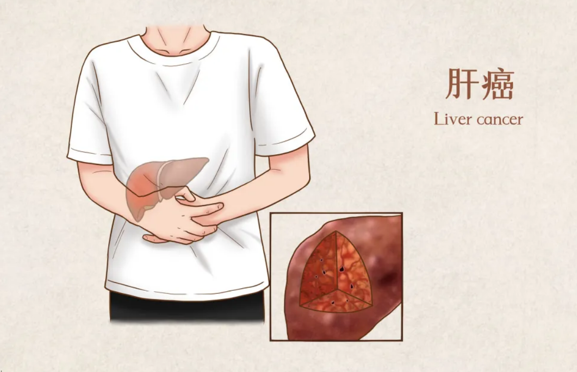 从脂肪肝—肝硬化—肝癌要多久？