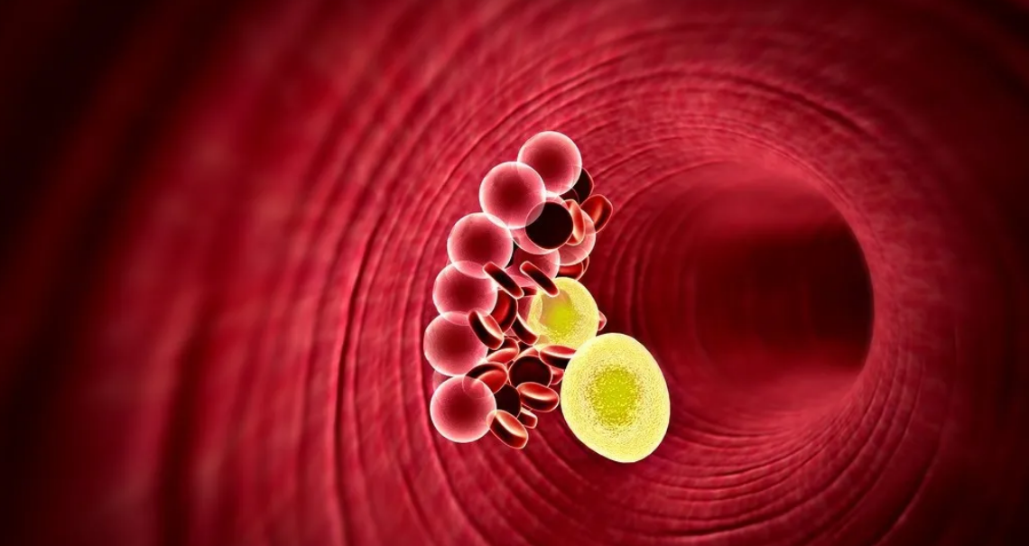 我们的身体可以自动清除血栓，为什么还有那么多人血管堵塞？