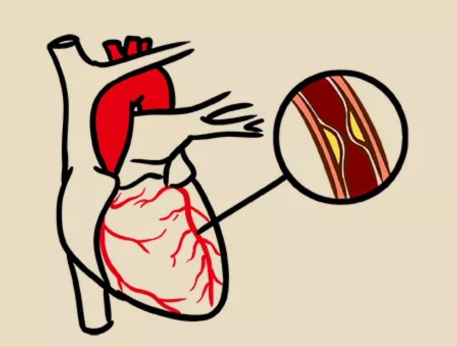 心血管疾病常用的6种检查方法，这篇全说透了