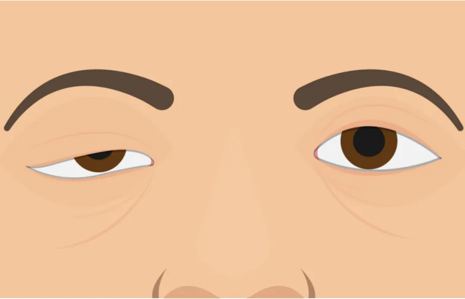 眼睑下垂、肌肉无力……重症肌无力是什么病？
