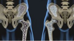 补钙对骨质疏松究竟有用吗？