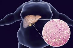 如何预防脂肪肝？大量运动真能“治愈”脂肪肝吗？
