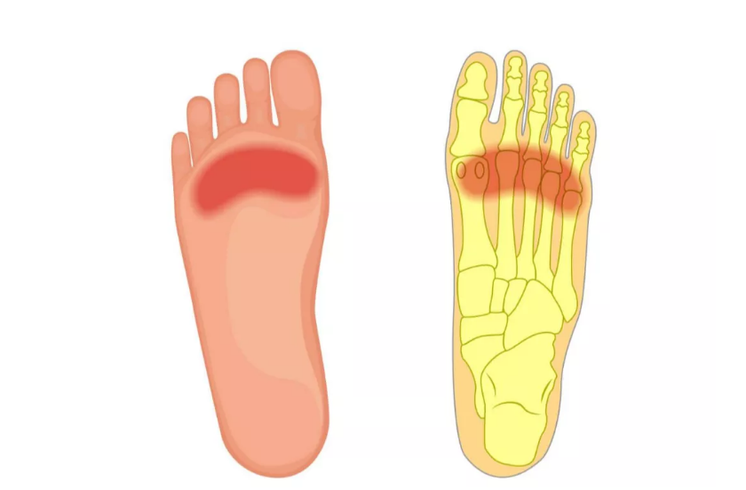 一份“双脚疼痛图解”，详解不同位置脚疼原因