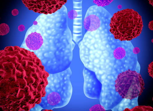肺是如何一步步被“气”出癌症的？