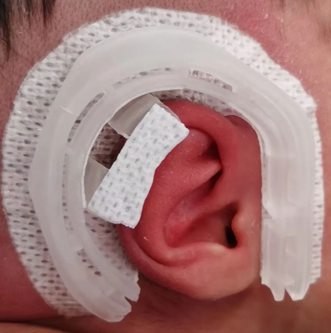 新生宝宝耳廓畸形,出生21天内有机会无创矫正_家庭健康终端_京智康