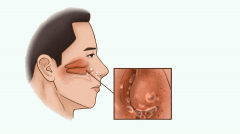 长期鼻塞可能导致血压升高！过敏性鼻炎患者如何重获鼻腔「自由」？