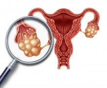 如何早期发现卵巢癌
